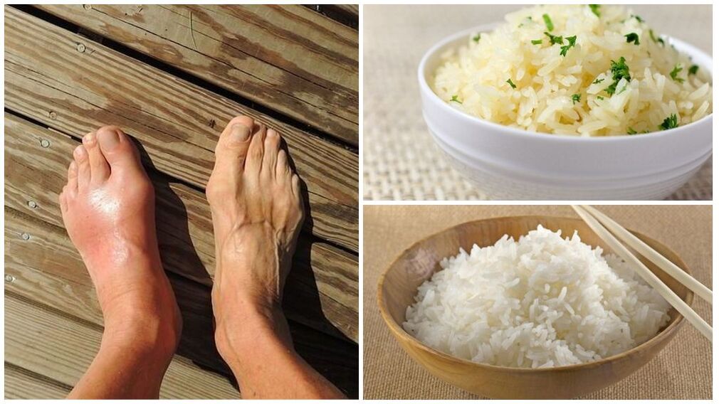 建议痛风患者以米饭为基础的饮食。